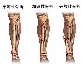 三步阶梯疗法--治疗骨折新疗法