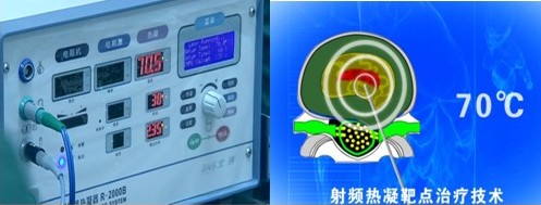 "grt射频热凝靶点术" 安全有效治疗颈椎病