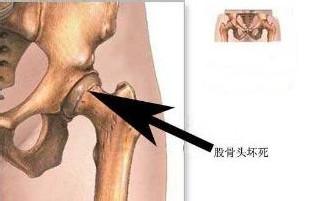 类风湿关节炎怎么预防
