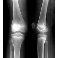 膝关节骨质增生是怎么造成的