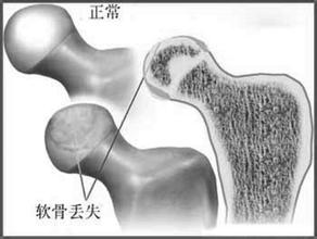 生活中要怎么预防股骨头坏死?