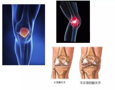 滑膜炎与风湿病有哪些区别