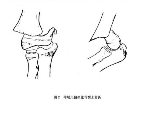 骨折发生的原因都是什么