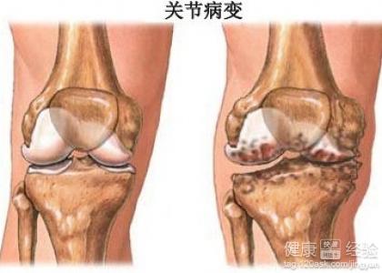 骨质增生病人需要注意哪些事项