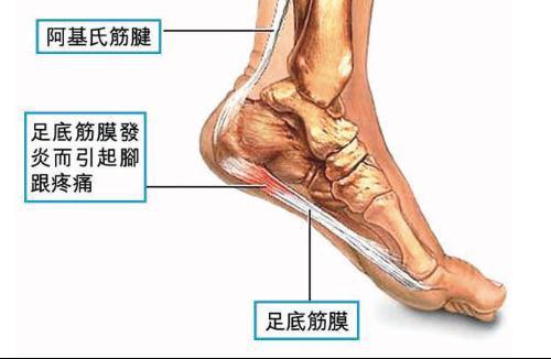足底筋膜炎有哪些症状