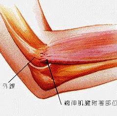 网球肘疾病需要注意些什么