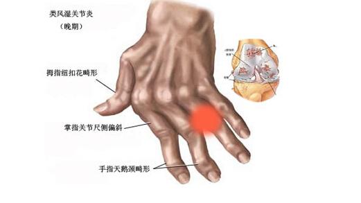 哪些因素会引起风湿病